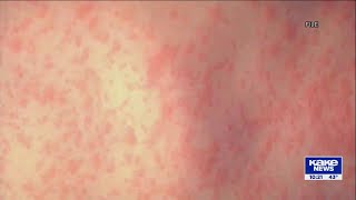 Measles cases continue to climb in Kansas, health officials urge vaccination