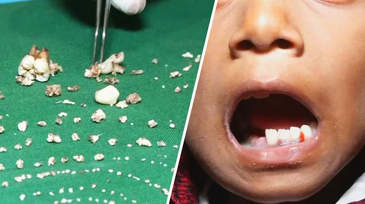 Doctors Remove Over 500 Teeth From Boy's Mouth - DayDayNews