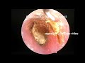 Ear wax removal extration,Treatment of dry piece ear wax and cerumen embolism, 14minutes