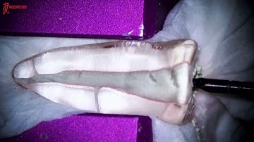 Using Vibrating 812 MT Endo Motor with MTA Compaction Endo