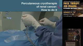9  Jochen Walz France   Cryoablation of renal masses and outcome in pT1b tumors