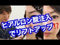 【ヒアルロン酸注入】ゴルゴライン、頬へのヒアルロン酸注入、ヒアルロン酸注入でリフトアップさせます！、cheek fillers