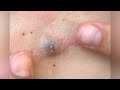 Giant acne removal  giant blackhead blackhead blackheads blackheadremoval acne removal