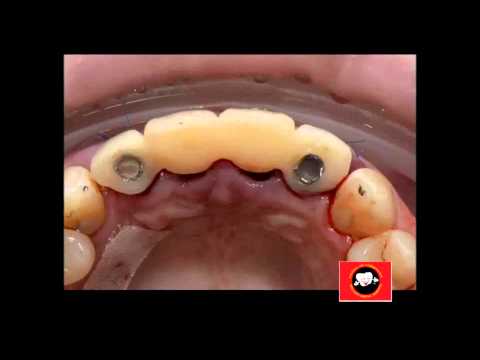 anterior-implant-placement-with-immediate-provisionalisation/immediate-implants-in-chennai
