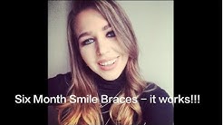 Six Month Smiles braces | Review |(my story) Your Questions answered