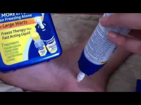 dr scholl's fast acting liquid wart remover