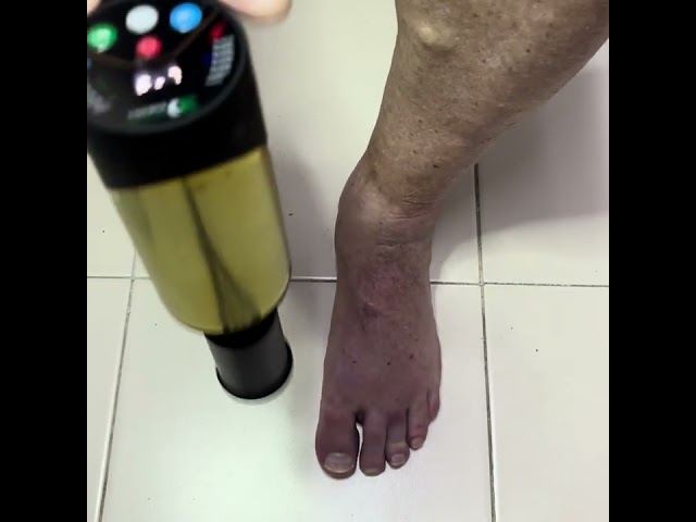 Extremity Percussion Therapy - Ankle
