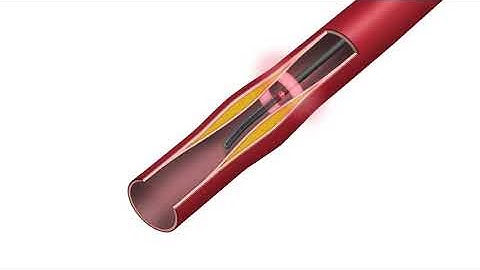 Nirtek NIRAF Guidewire Explained