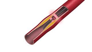 Nirtek NIRAF Guidewire Explained