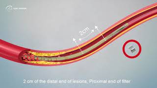 Operation vedio of TJWY Proender® Disposable Embolic Protection Device