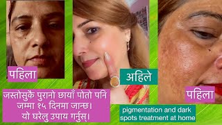 जस्तोसुकै पुरानो चाया पोतो पनि | जम्मा १५ दिनमा जान्छ। यो घरेलु उपाय गर्न।|Pigmentation  Treatment |