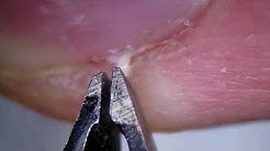 Hangnail Removal Under the Microscope