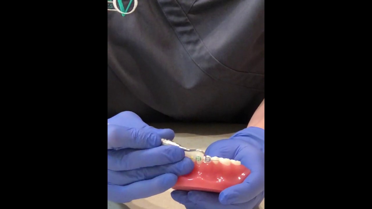 Removing a orthodontic elastic in case of emergency