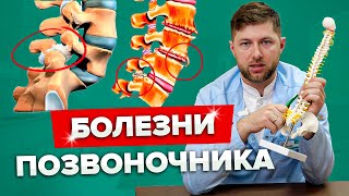 Спондилоартроз | Спондилез | Спондилолиз: Разбираемся в Отличиях