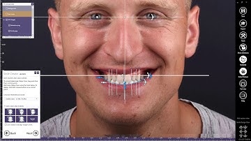 exocad Smile Creator Now Integrated with Carestream Dental