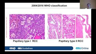 UROWebinar: WHO 2022 Classification of Male Genitourinary Tract tumor: What is relevant?