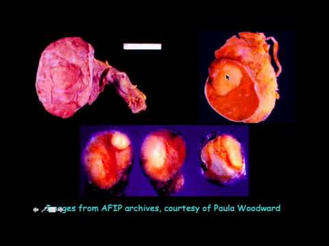 Mass in the Scrotum  What Does It Mean Ultrasound Video