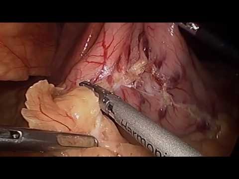 Sleeve Gastrectomy With Jejunal Bypass 2015