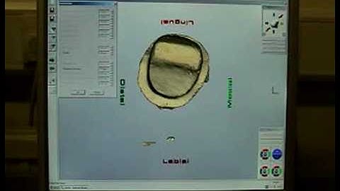 Restoring a tooth (CAD-CAM Ceramic) - Part 1