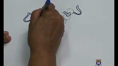 Designing a Lower Metal Partial Denture Kennedy Class I