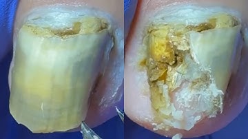 The Bad Nails Almost Fell Off And The Inside Was Like Sludge!【Dr. Liu