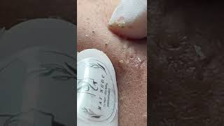 BLACKHEAD - Acne Treatment Mai Ngoc #maingoc #acnetreatments #acne #blackheads