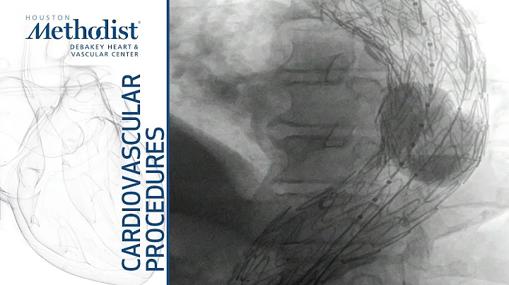 TEVAR for Descending Thoracic Aneurysm (A Lumsden ...