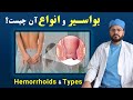 بواسیر چیست و انواع بواسیر چیست داکترستان What Is Hemorrhoid Types Doctoristan بواسیر چیست و انواع بواسیر چیست داکترستان What Is Hemorrhoid Types Doctoristan