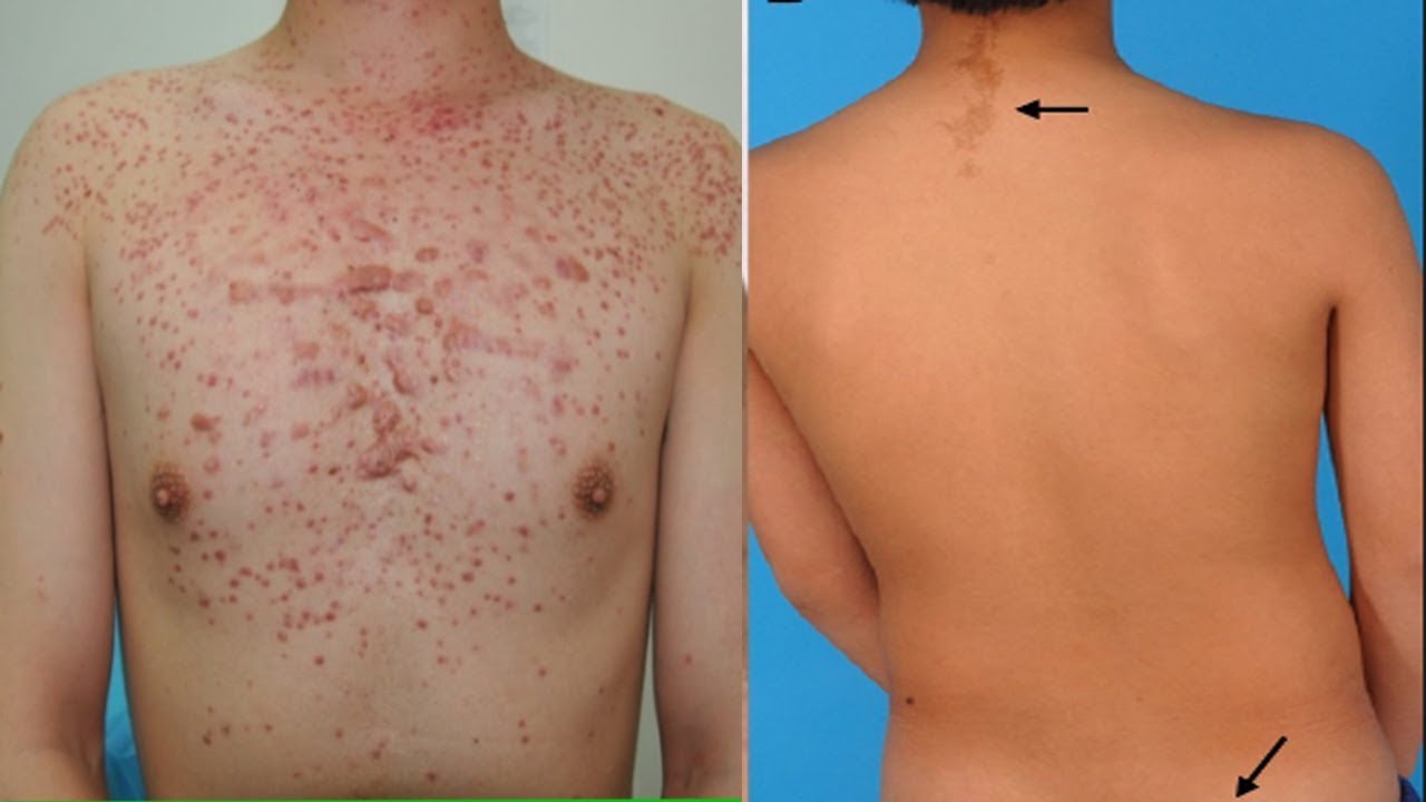 HYPER PIGMENTATION and ACNE SCARS |Dry for Normal & Oily Skin