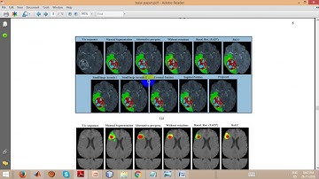 Brain Tumor Segmentation using Convolutional Neural Networks in MRI Images
