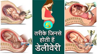 Types of Baby delivery I Delivery होने के तरीके I Types of childbirth