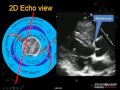 A/Prof Greg Scalia: Imaging the aortic valve