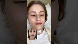 Контурная пластика губ👄