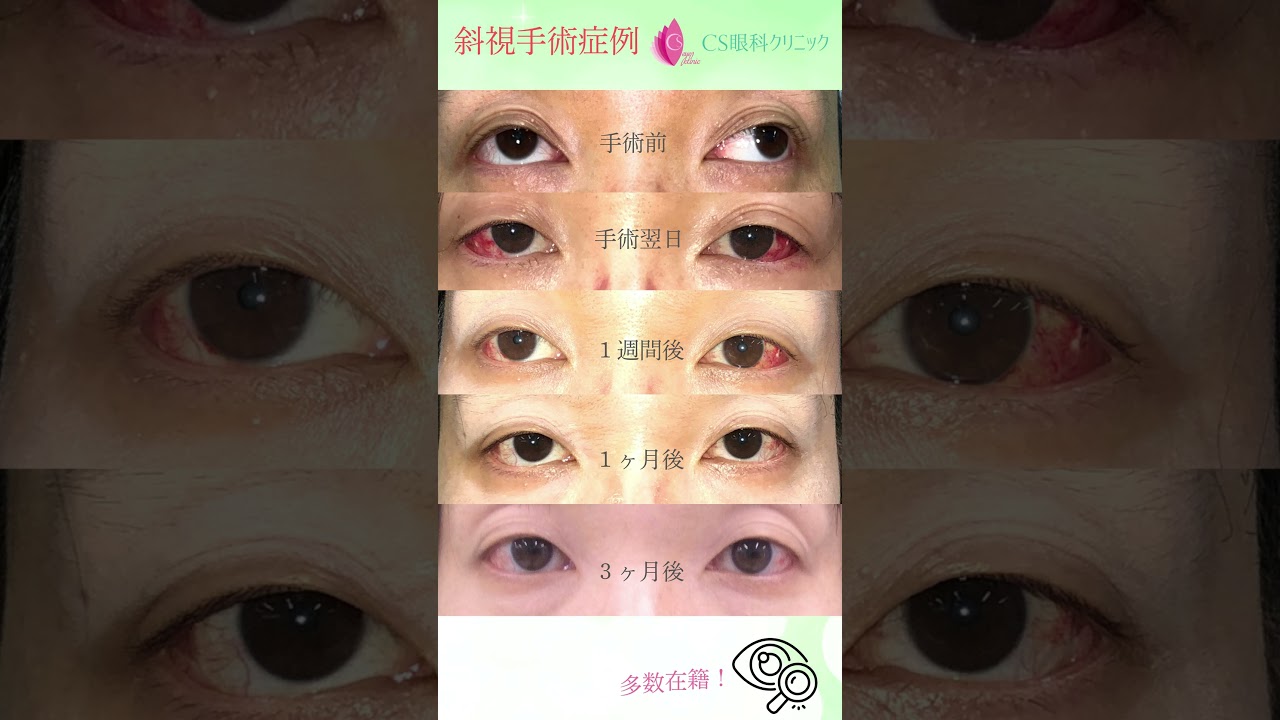 斜視治療のストラテジー 53症例 画像760点 斜視治療のストラテジー
