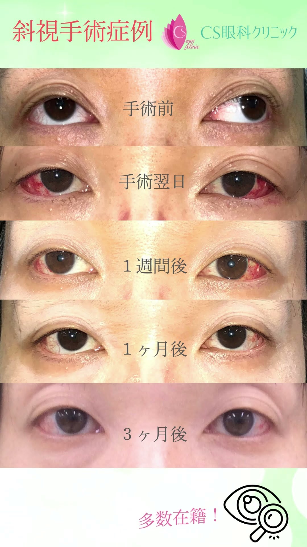 斜視手術症例 ＃斜視＃斜視手術＃眼科＃ガチャ目＃眼精疲労 - YouTube