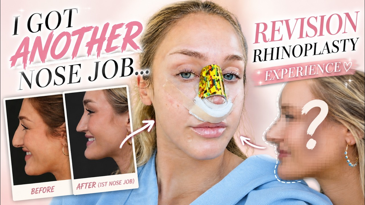 I got ANOTHER NOSE JOB...my revision rhinoplasty experience