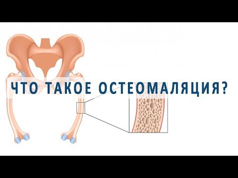 Видео: Что такое остеомаляция?