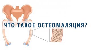 Что такое остеомаляция и как она лечится? Что такое остеомаляция и как она лечится?