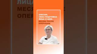 Олесия. СМАС-подтяжка лица и шеи. Месяц после операции
