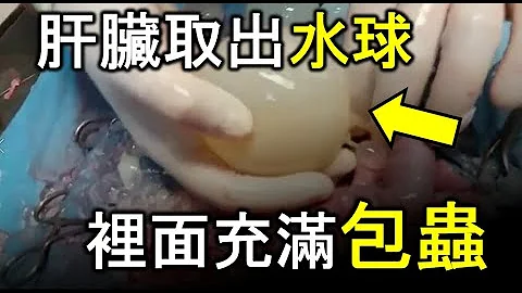 絛蟲三公分竟然比15米絛蟲可怕? 包蟲病台灣也曾有!  hydatid disease| 寄生蟲 | 絛蟲 - 天天要聞