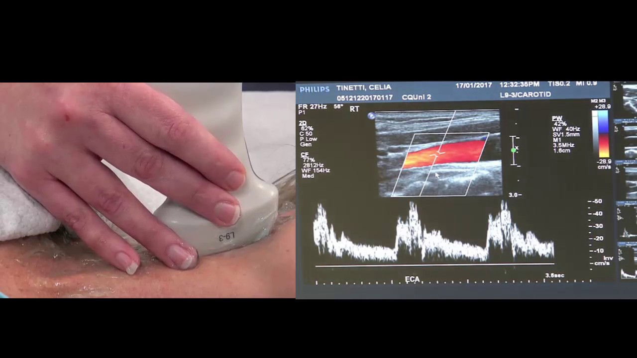 Sonography - Carotid scan