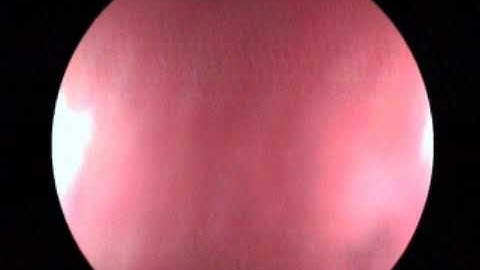 Total gastrectomy with esophagojejunostomy