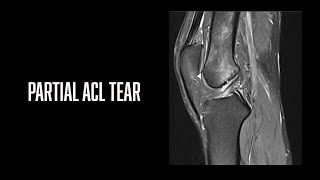 Partial ACL tear MRI knee #TheReportingRoom