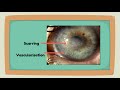 Educational video to support diagnosis of Herpes Simplex Keratitis