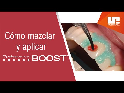 Video: ¿Funciona el blanqueamiento dental opalescente?