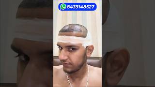 Hair Transplant Result Of 2000 Grafts vs. 5000 Grafts 🔥🔥🔥 #hairtransplantresults