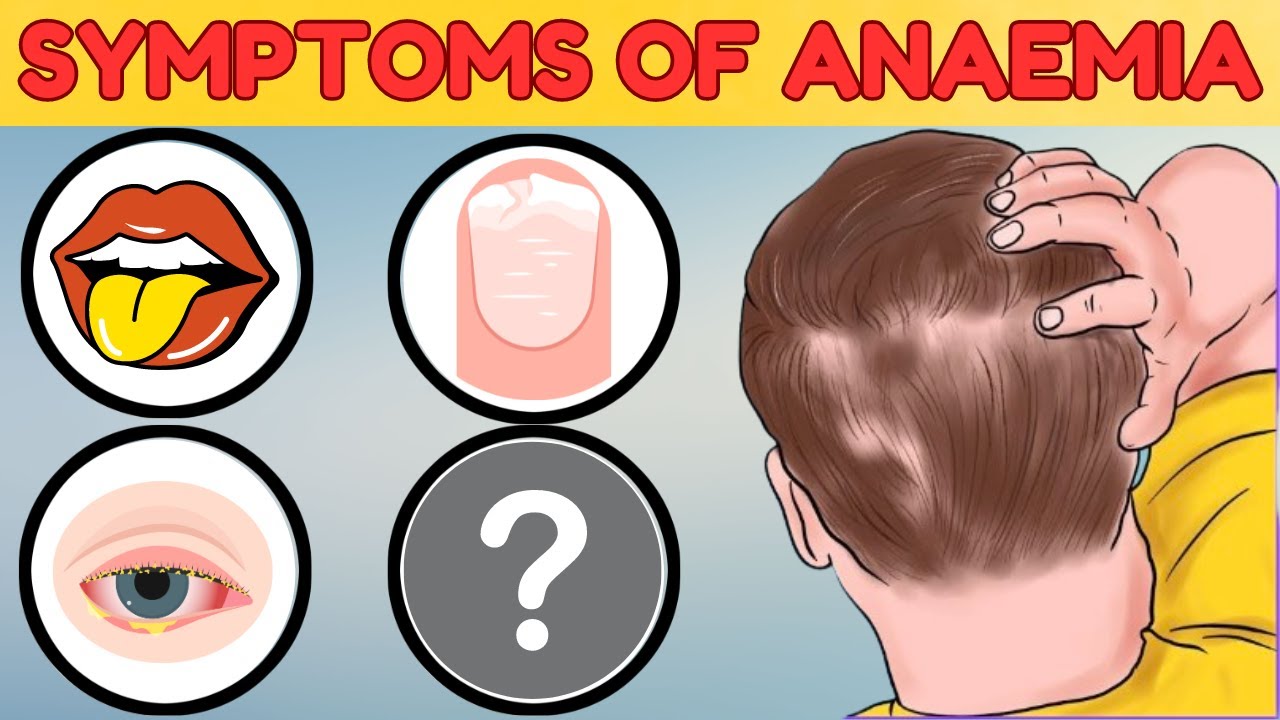 8 Silent Symptoms of Anemia You Shouldn't Ignore! - YouTube