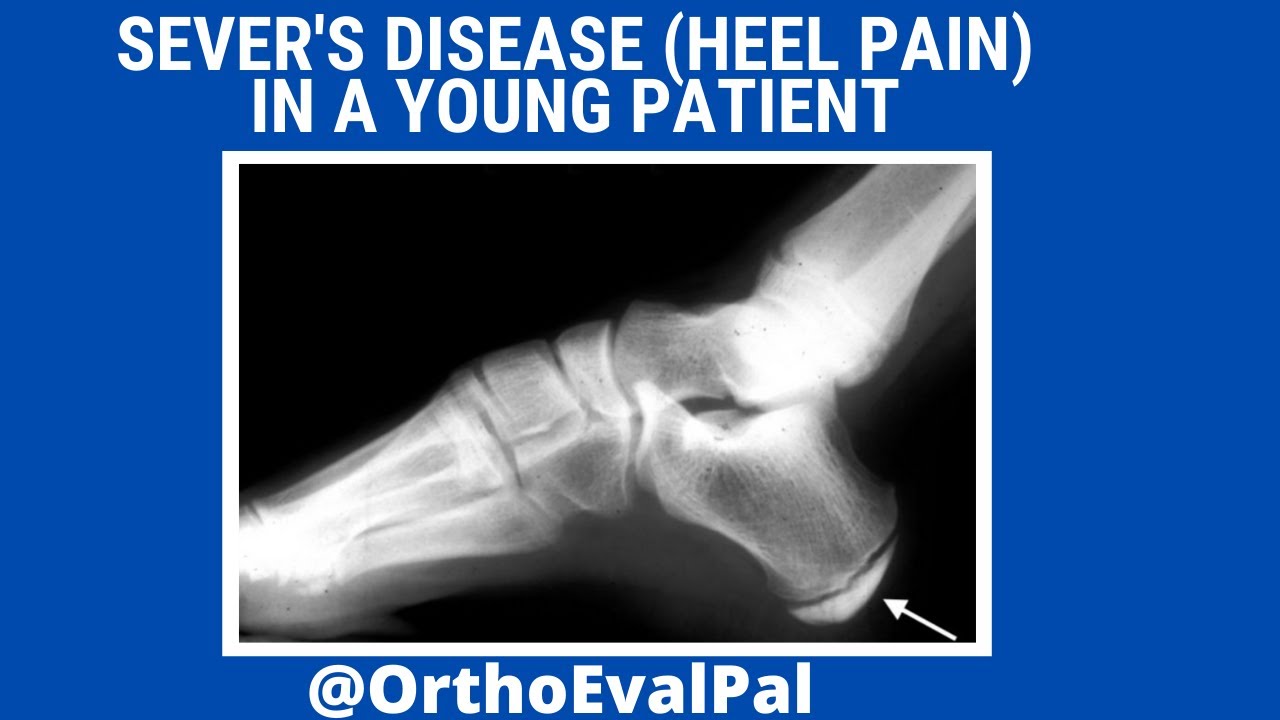 Sever's Disease (Heel Pain) in a Young Patient YouTube