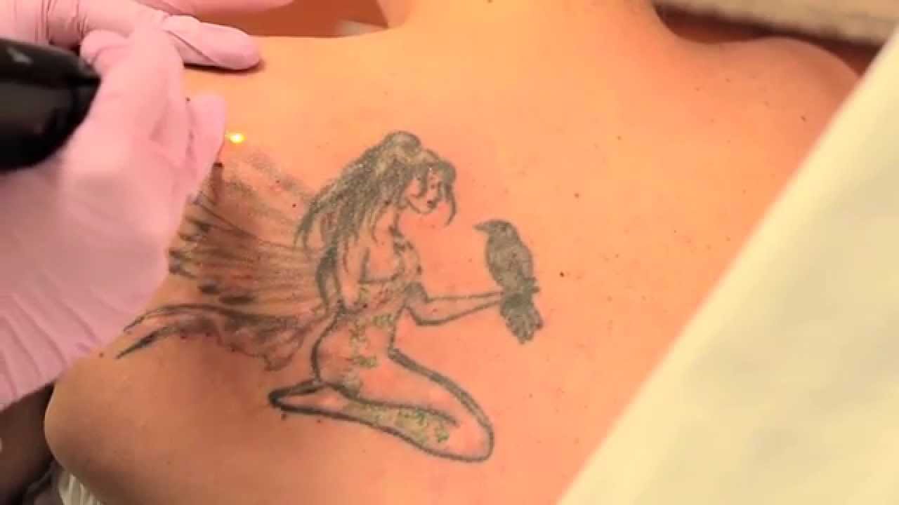 PicoSure Tattoo Removal - Aftercare - YouTube