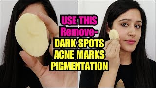APPLY THIS ON YOUR FACE to Remove DARK SPOTS, PIMPLE MARKS & PIGMENTATION